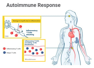 A diagram about the autoimmune response to multiple sclerosis.